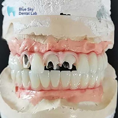 kupować Titanium Malo Bridge Implant Bridge bez wielojednostkowego podnośnika online manufacture