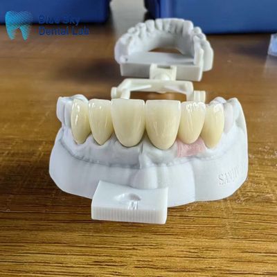 kupować Wysoko przejrzyste, złożone warstwy zirkonia naturalne korony z implantami online manufacture