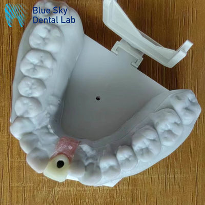 kupować Sterylizacja parą Korona pojedynczego implantu Korona gładkiej powierzchni Korona implantu dentystycznego online manufacture