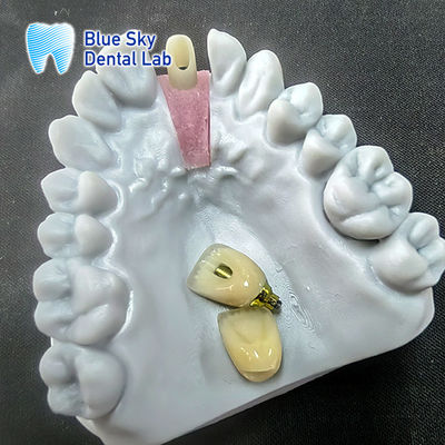 kupować Precyzyjnie frytowane zirkonia z pojedynczą koroną implantów online manufacture