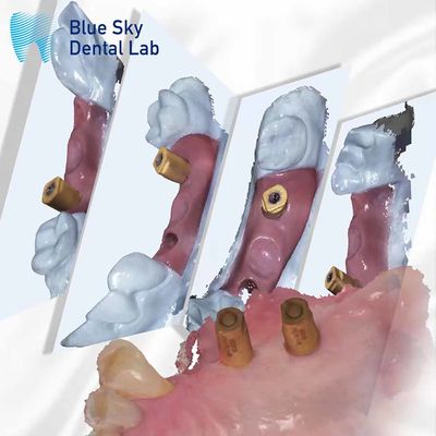 kupować Skanowanie ciała w jednym Kapsułka do uzdrawiania zębów System implantów Blue Sky online manufacture