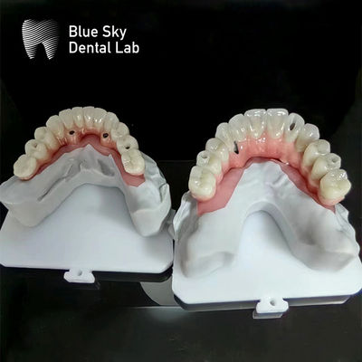 kupować Implant Blue Sky Full Arch Implant Case Natury Implant Case online manufacture