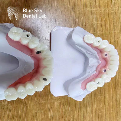 kupować Zębowe zestawy z wieloma implantami z indywidualnymi implantami online manufacture