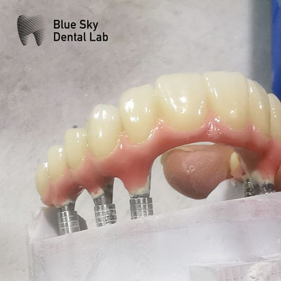 kupować Naturalny kształt Całkowity łuk Implant Kasy Gładka powierzchnia Kasy implantów dentystycznych online manufacture