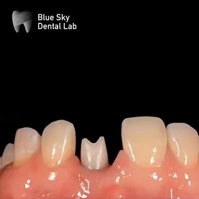 kupować Implant zębowy hipoalergiczny Zirconia Abutment Biokompatybilny online manufacture