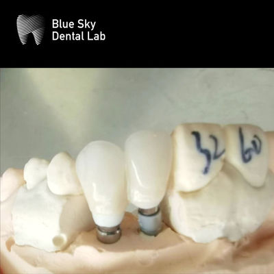 kupować Pojedyncze korony Zirconia Abutment Hypoallergenic Implanty zębowe Zirconia Abutment online manufacture