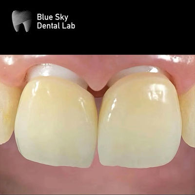kupować Zwarstwiony Zirkonia Implant Korona Zirkonia Abutment Biokompatybilny online manufacture