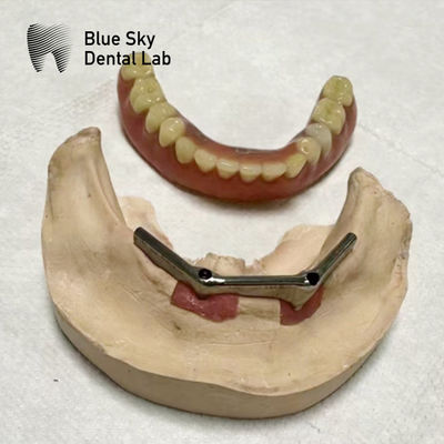 kupować Implant Nadprzęg Tytanowy Przęg Zębowy Implant ze zdejmowalną protezą online manufacture