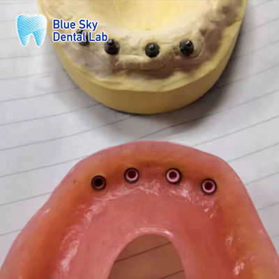 kupować Zdejmowalny lokalizator odbudowy implantu, implant zębowy, odbudowa całego ust online manufacture