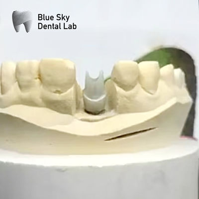 Implant z zirkonii estetycznej, biokompatybilny, precyzyjnie fresowany