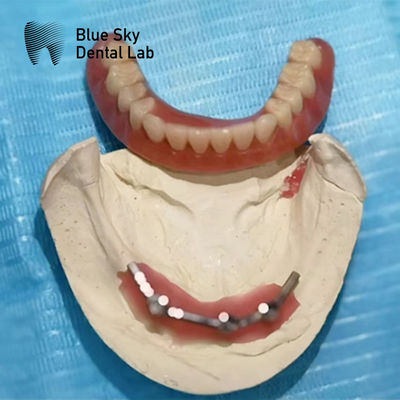 Blue Sky Implant Titanium Bar Dental For Implant Dentures